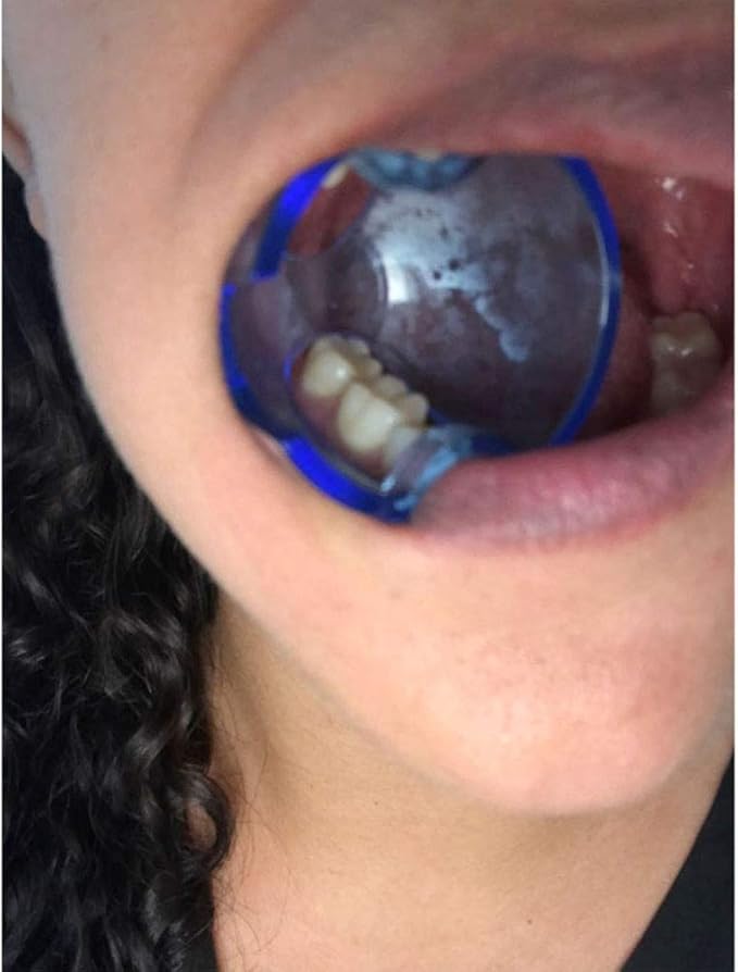 Dental Orthodontic Lip Cheek Retractor Expander Mouth Opener Autoclavable for Posterior Teeth (15 Pieces/lot)