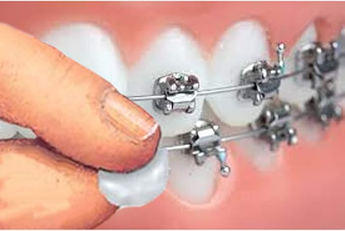 Genuine Orthowax - Orthodontic Wax for Braces Wearer - Stick Better Than competitors