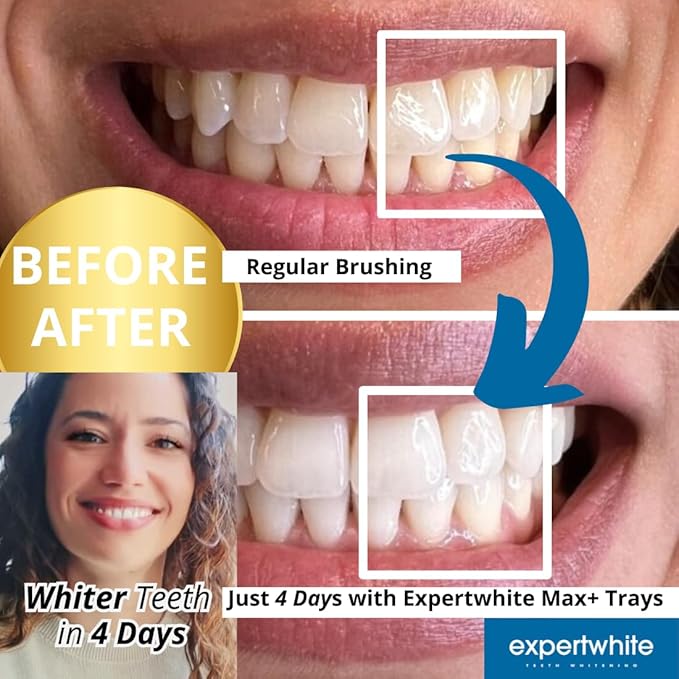 Max Glow Trays – 12HP Prefilled Teeth Whitening Trays – 10 Treatments, 12% Hydrogen Peroxide Gel. Custom-Fit. Enamel Safe. On-The-Go Better Than Strips. Suitable Sensitive Teeth.