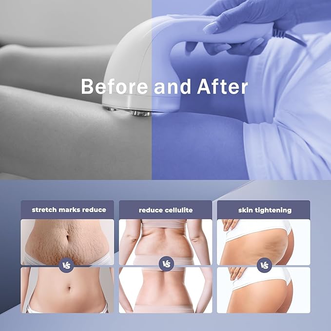 Radio Frequency Induced Heat-Palm NRG Cellulite Body Device-StrideForce Fitness