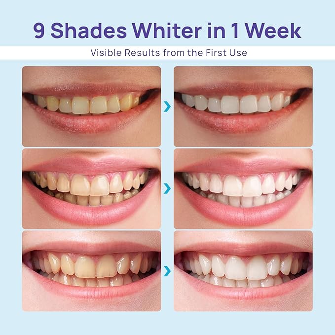 Whitebite Pro Teeth Whitening Kit for Sensitive Teeth – LED Light + 35% Carbamide Peroxide Gel + Remineralizing Gel | Premiuml-Grade Results at Home
