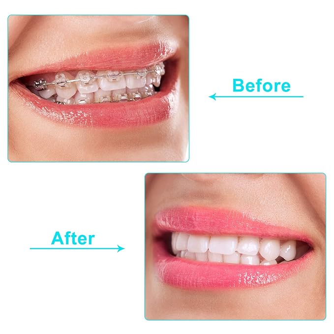 20 Pieces Aligner Tray Seaters for Aligner Trays Chompers Orthodontic Trays(Pink, Orange, Green, Purple, White)