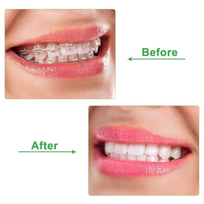 20 Pieces Aligner Tray Seaters for Aligner Trays Chompers Orthodontic Trays(Green)