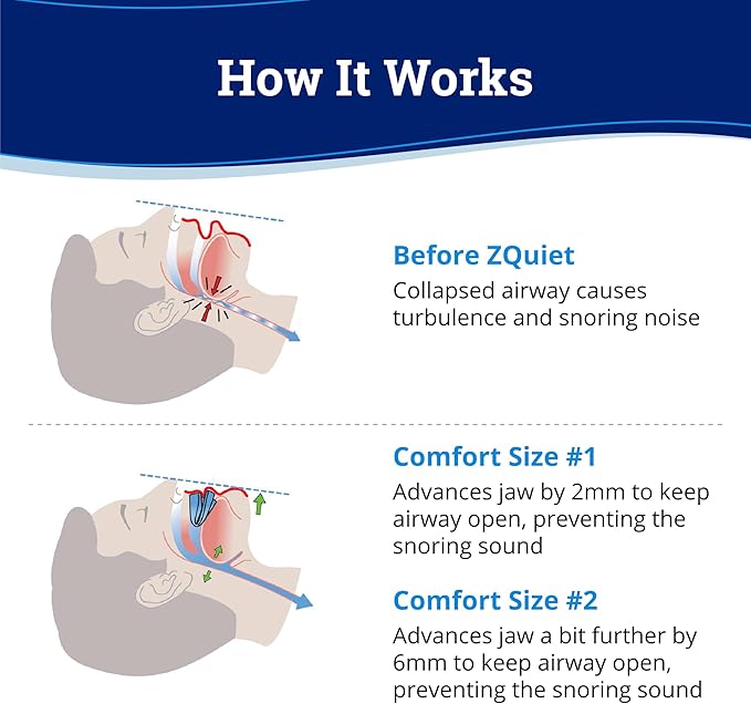 ZQuiet Anti-Snoring Mouthpiece Solution, 2 Size Comfort System Starter Kit + Nasal Dilator (2 Pack / 30 Day Supply) - Made in USA & FDA Cleared